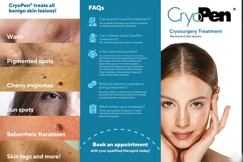 Benefits of Cryopen for seborrheic keratosis Removal Treatment Milngavie 